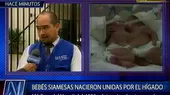 SIS cubrirá los gastos de tratamiento médico a siamesas que nacieron en Trujillo - Noticias de siameses