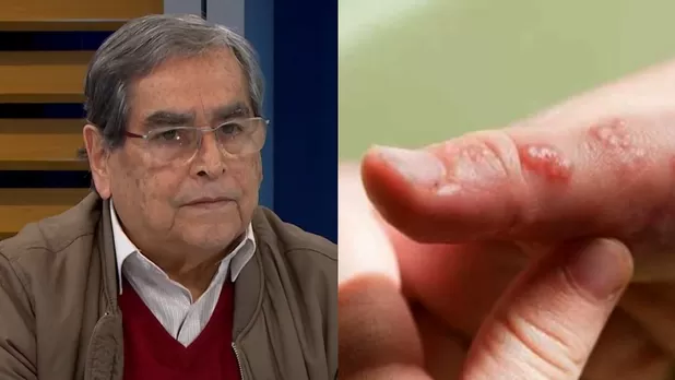 Ugarte sobre viruela del mono: "La variante 1 no llegó al Perú"