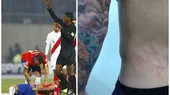 Así quedó la espalda de Charles Aránguiz tras entrada de Carlos Zambrano - Noticias de charles-bolden