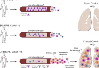 COVID-19 afecta diferentes células del sistema inmunitario según la gravedad