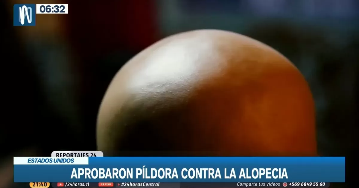 Estados Unidos: Aprobaron la primera píldora contra la alopecia