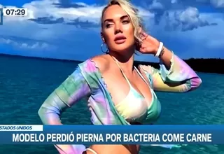 Modelo perdió la pierna por bacteria come carne tras vacacionar en las Bahamas 