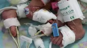 Pucallpa: siamesas viajarán a Lima para intervención quirúrgica - Noticias de pucallpa
